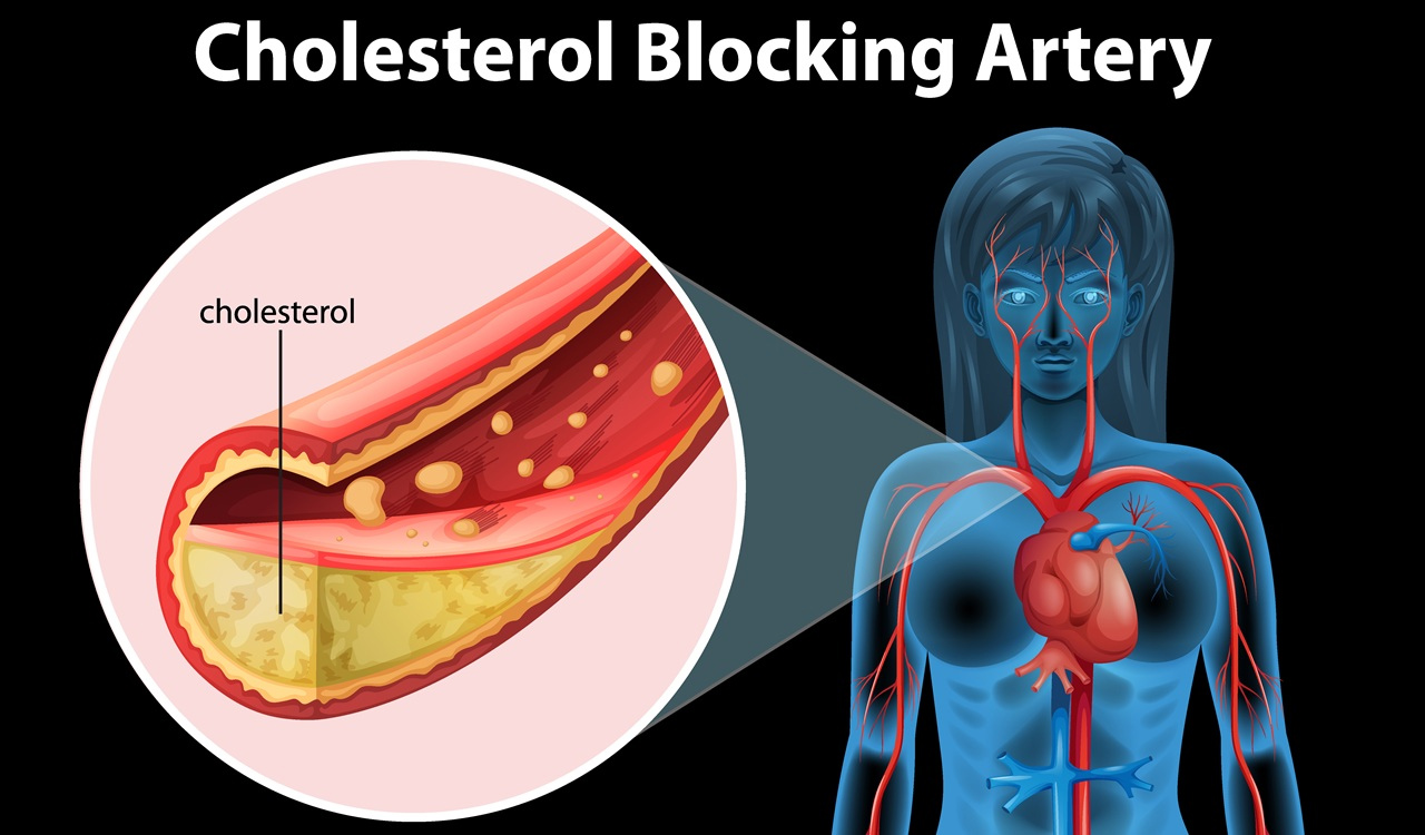 Cara Menurunkan Kolesterol Jahat dari Tubuh Tanpa Obat Seumur Hidup yang Ditemukan Dokter
