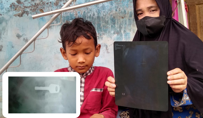Anak Yatim di Indramayu Telan Kunci Gembok, Hasil Rontgen Menunjukkan Kunci Bersarang di Lambung