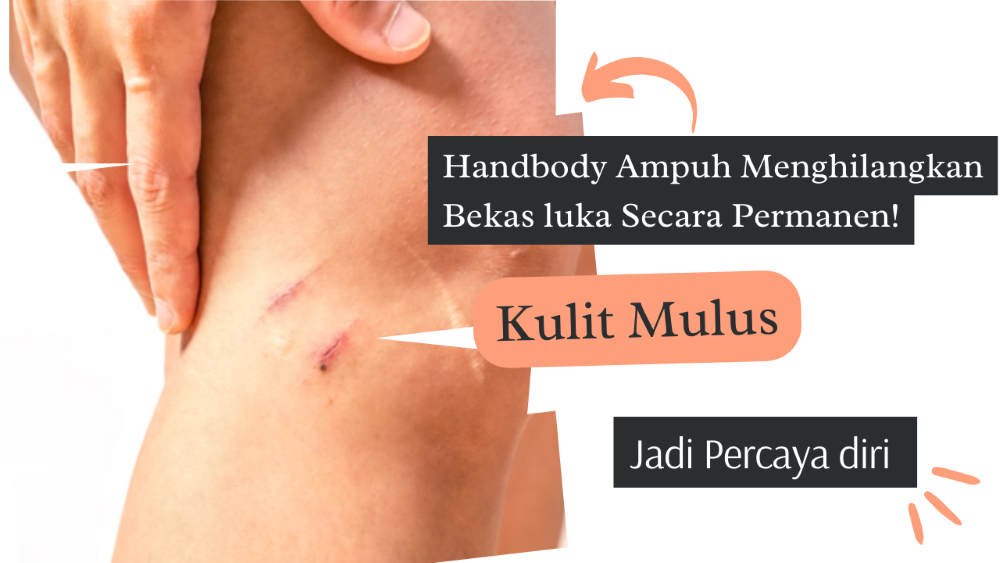 Handbody Terbaik untuk Menghilangkan Bekas Luka Hitam dengan Cepat dan Membuat Kulit Mulus 