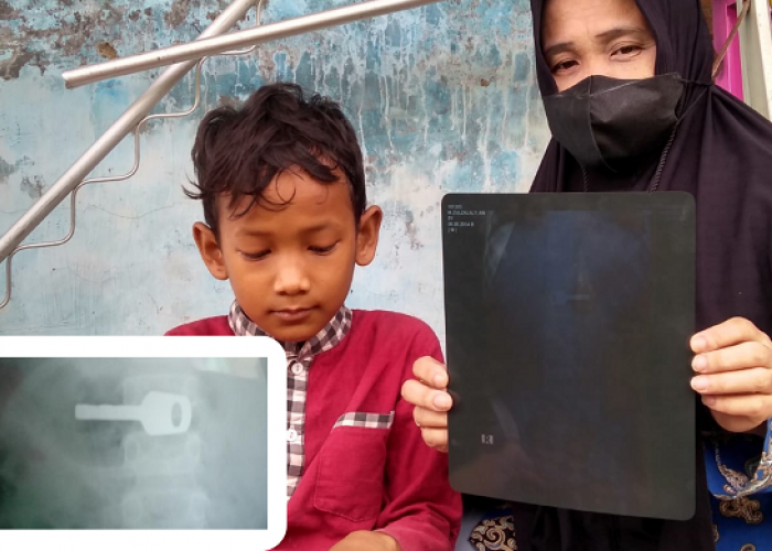 Anak Yatim di Indramayu Telan Kunci Gembok, Hasil Rontgen Menunjukkan Kunci Bersarang di Lambung