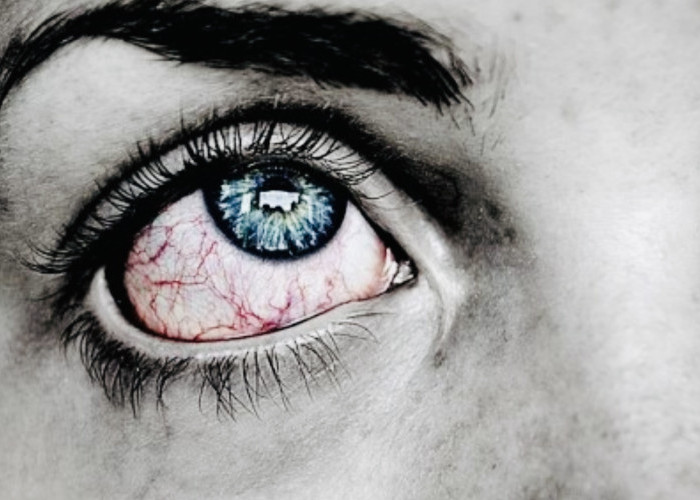 Waspadai Stroke Mata, Bisa Menyebabkan Kebutaan Akibat Sumbatan Darah ke Retina 