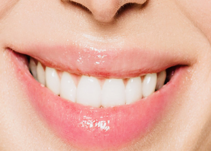 Cara Memutihkan Gigi Secara Alami, Supaya Tidak Minder dan Tak Percaya Diri